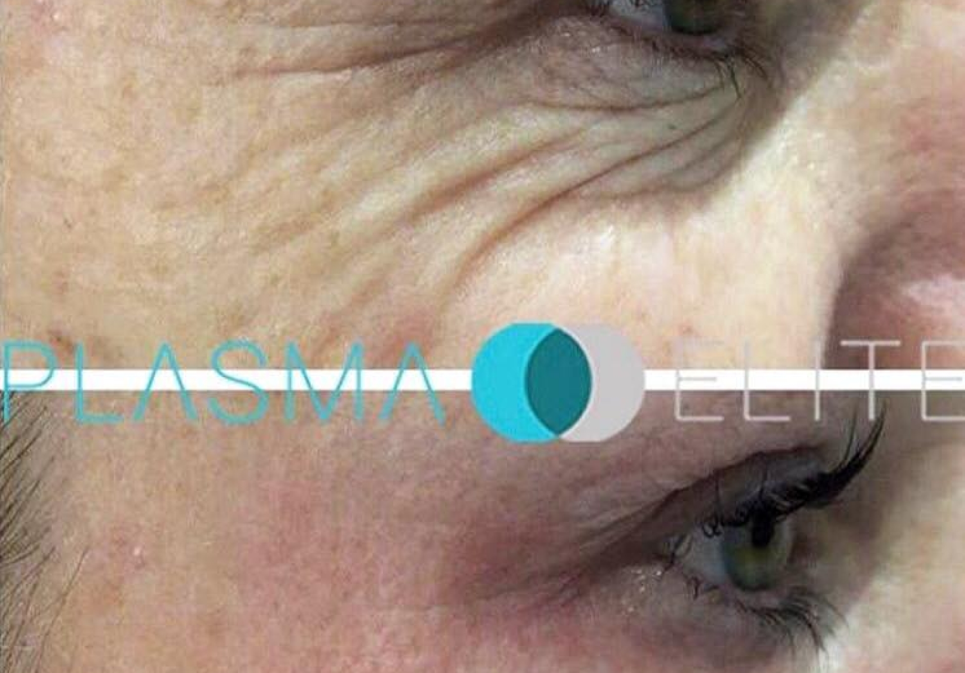 Crows Feet The Solution
