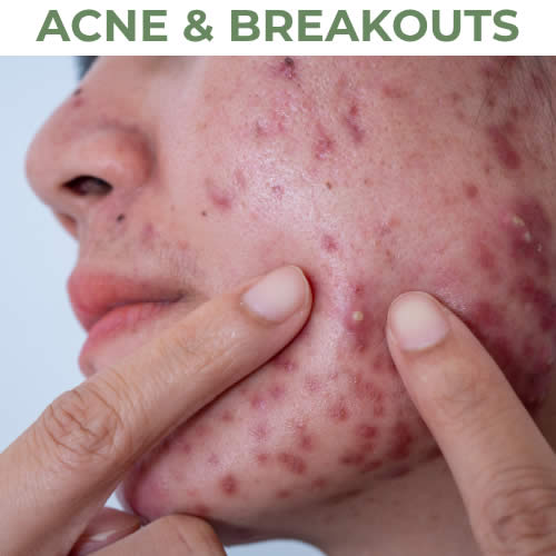 Acne & Scars