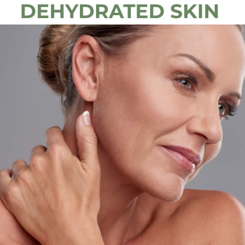 Dehydrated Skin