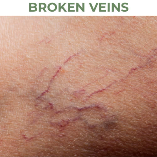 Broken Veins