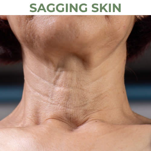 Sagging Skin