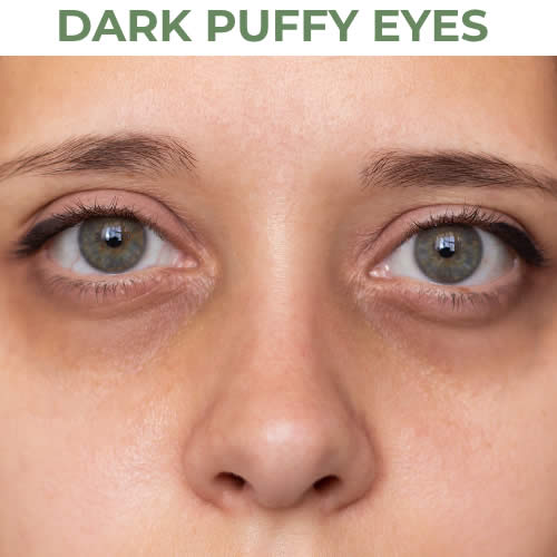 Dark Puffy Eyes