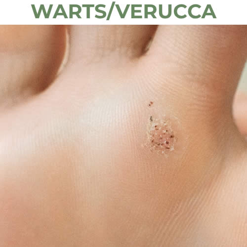 Warts/Verucca