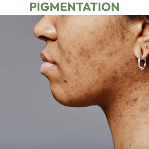 Pigmentation