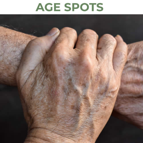 Age Spots