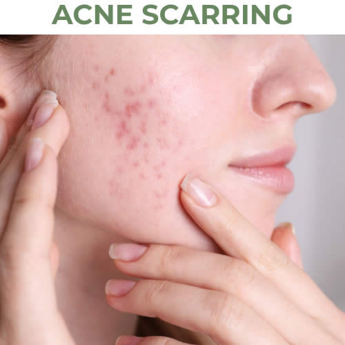 Acne Scarring