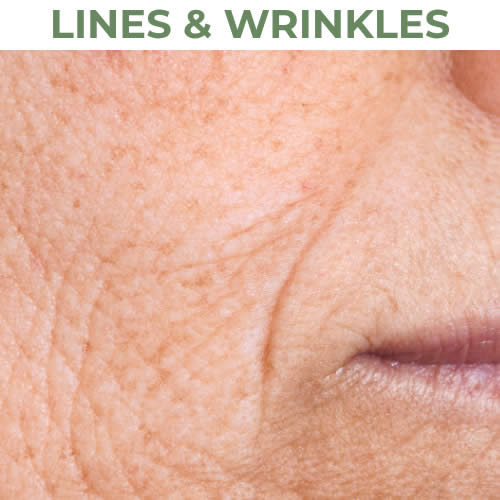 Lines & Wrinkles