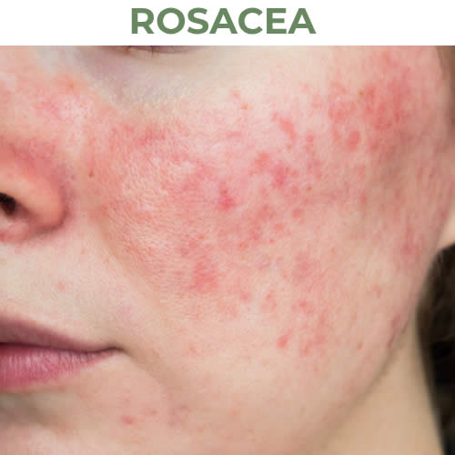 Rosacea