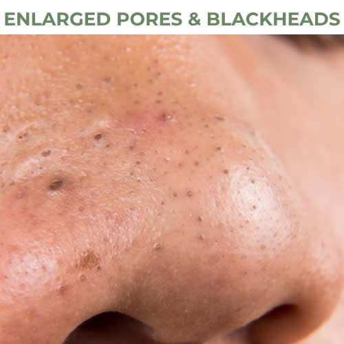 Enlarged Pores & Blackheads