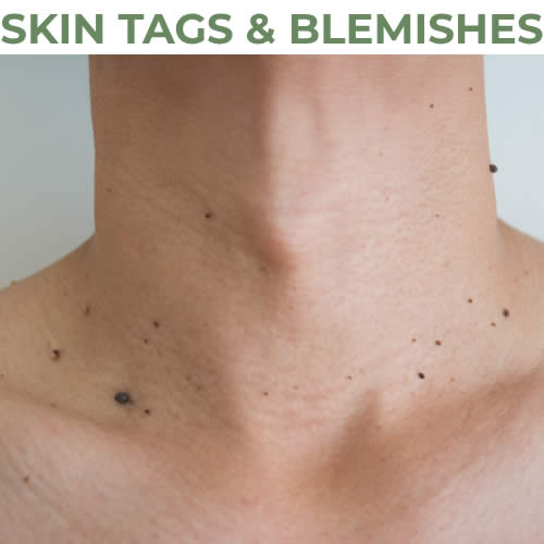 Skin Tags & Blemishes