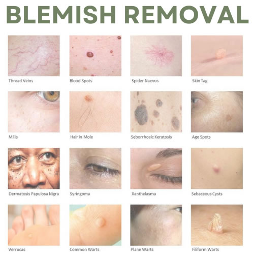 Blemish Removal