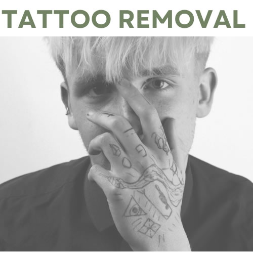 Tattoo Removal
